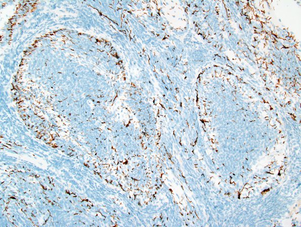 7D3 Medulloblastoma, desmoplastic (Case 7) GFAP.jpg