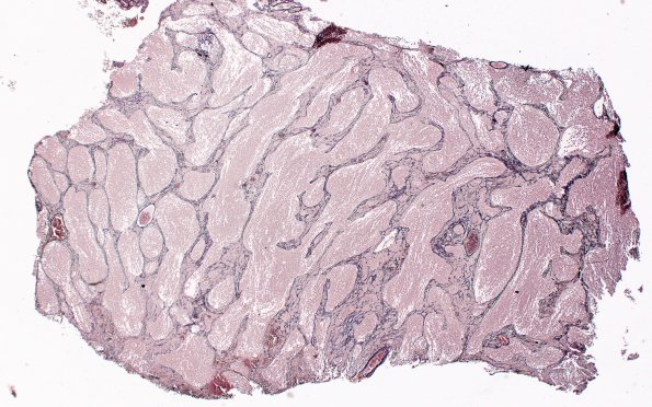 7E1 Medulloblastoma, desmoplastic (Case 7) Retic 4xa