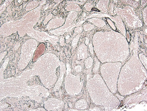 7E2 Medulloblastoma, desmoplastic (Case 7) Retic 1.jpg