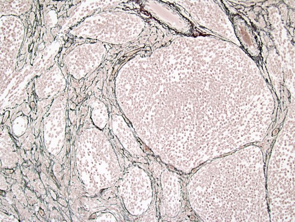 7E3 Medulloblastoma, desmoplastic (Case 7) Retic 2.jpg