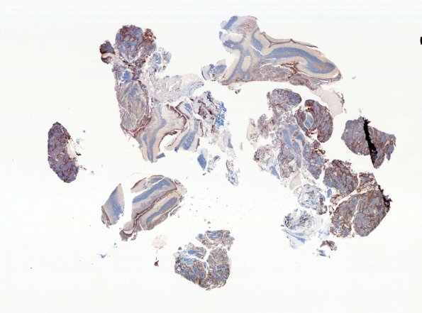 7F1 Medulloblastoma, desmoplastic (Case 7) Ki-67 WM