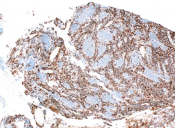 7F2 Medulloblastoma, desmoplastic (Case 7) Ki67 4X