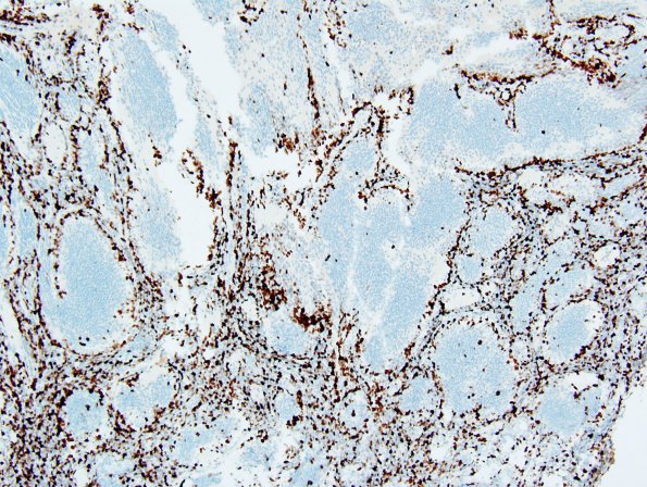 7F3 Medulloblastoma, desmoplastic (Case 7) Ki-67 3.jpg