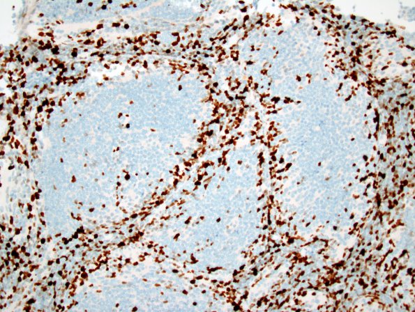 7F4 Medulloblastoma, desmoplastic (Case 7) Ki-67 2.jpg