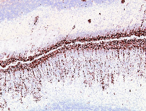 7F5 Medulloblastoma, desmoplastic (Case 7) Ki-67 4