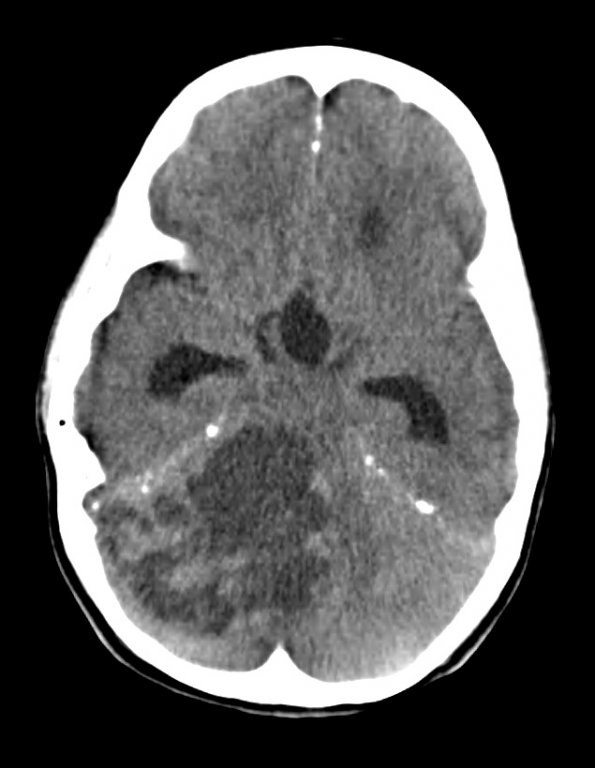 8A1 Medulloblastoma, desmoplastic (Case 8) CT 1 - Copy