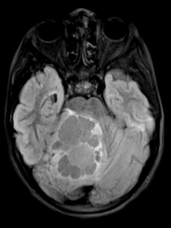 8A2 Medulloblastoma, desmoplastic (Case 8) FLAIR 1 - Copy