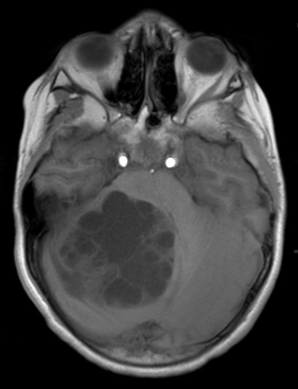 8A3 Medulloblastoma, desmoplastic (Case 8) T1 7 - Copy