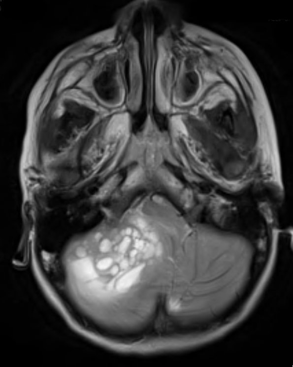 8A4 Medulloblastoma, desmoplastic (Case 8) T2 1 - Copy