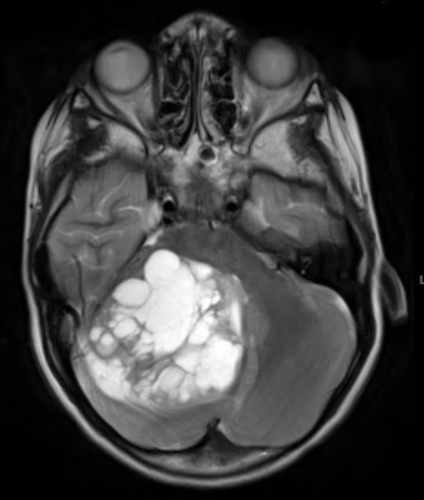 8A5 Medulloblastoma, desmoplastic (Case 8) T2 2 - Copy