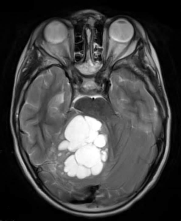 8A6 Medulloblastoma, desmoplastic (Case 8) T2 3 - Copy