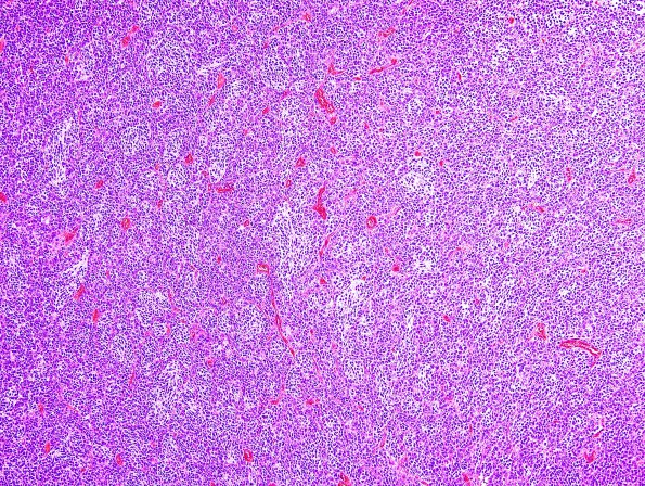 8B1 Medulloblastoma, desmoplastic (Case 8) H&E 4