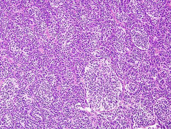 8B2 Medulloblastoma, desmoplastic (Case 8) H&E 10