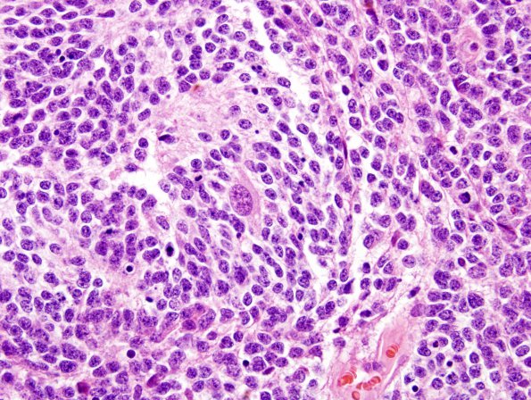 8B6 Medulloblastoma, desmoplastic (Case 8) H&E 8 (neurons)