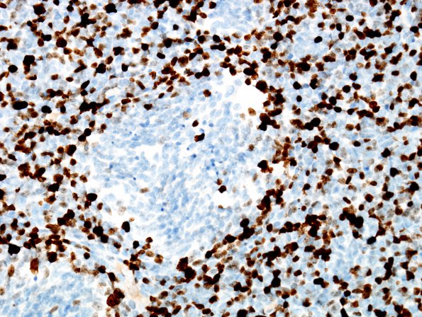 8E3 Medulloblastoma, desmoplastic (Case 8) MIB 2