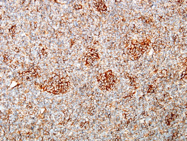 8F1 Medulloblastoma, desmoplastic (Case 8) b-catenin 3