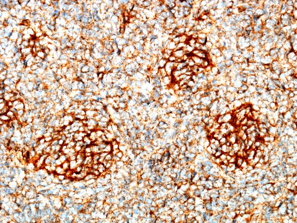 8F2 Medulloblastoma, desmoplastic (Case 8) b-catenin 4