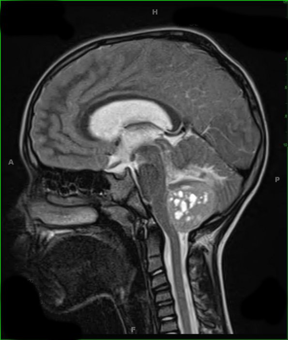 9A1 Medulloblastoma, desmoplastic focal anaplasia (Case 9)