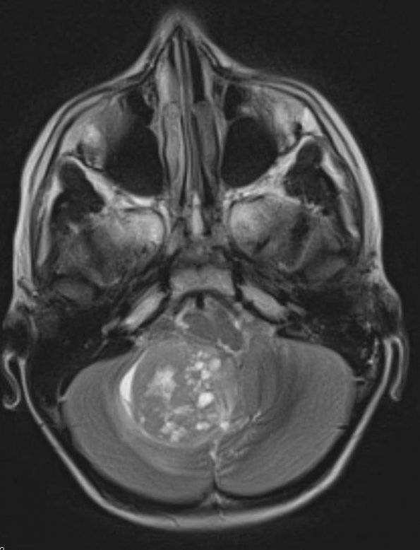 9A2 Medulloblastoma, desmoplastic focal anaplasia (Case 9)  T2 1 - Copy