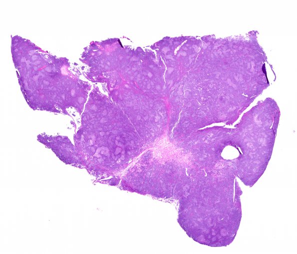 9B1 Medulloblastoma, desmoplastic & focal anaplasia (Case 9) H&E  WM