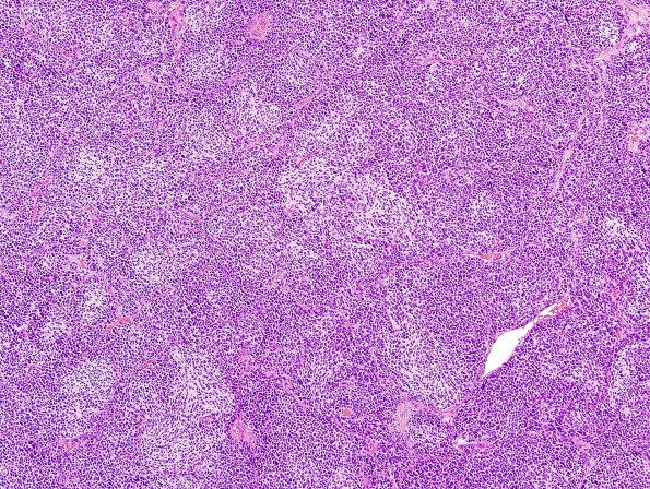 9B2 Medulloblastoma, desmoplastic & focal anaplasia (Case 9)  H&E 3