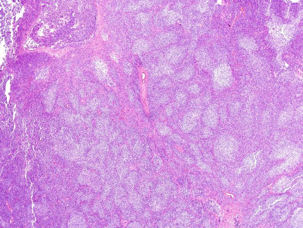 9B3 Medulloblastoma, desmoplastic, nodular (Case 9) H&E 2.jpg