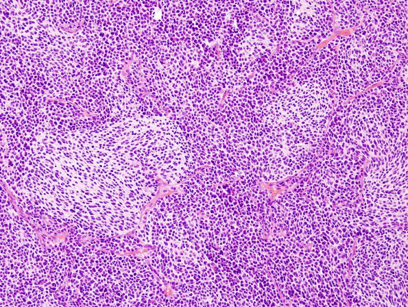 9B4 Medulloblastoma, desmoplastic focal anaplasia (Case 9)  H&E 4