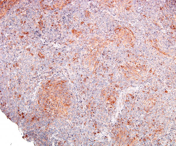 9C1 Medulloblastoma, desmoplastic focal anaplasia (Case 9)  SYN 3