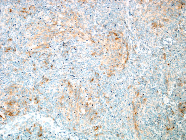 9C2 Medulloblastoma, desmoplastic focal anaplasia (Case 9)  SYN 2