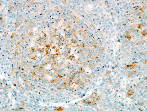 9C3 Medulloblastoma, desmoplastic focal anaplasia (Case 9)  SYN 1