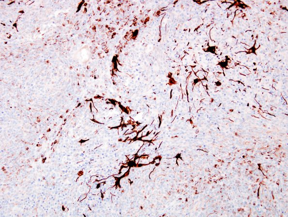 9E1 Medulloblastoma, desmoplastic & focal anaplasia (Case 9) GFAP 2