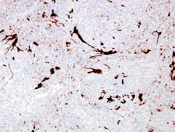 9E2 Medulloblastoma, desmoplastic & focal anaplasia (Case 9) GFAP 1