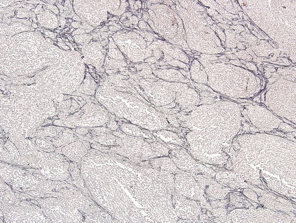 9F1 Medulloblastoma, desmoplastic & focal anaplasia (Case 9)  Retic 2