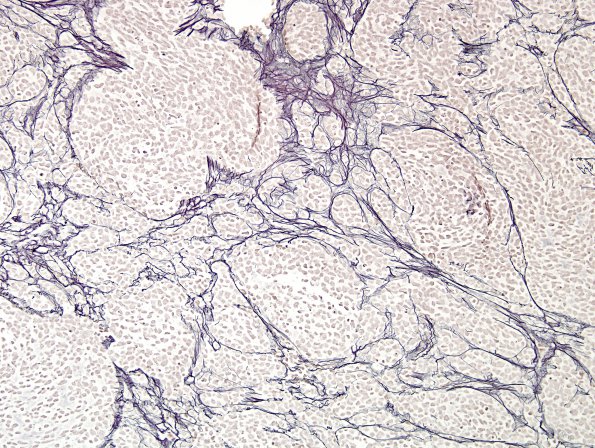 9F2 Medulloblastoma, desmoplastic focal anaplasia (Case 9)  Retic 1