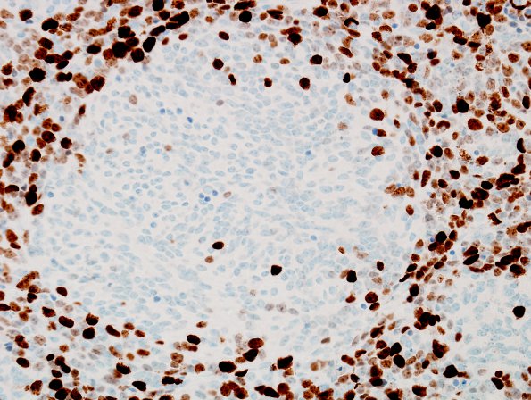 9G3 Medulloblastoma, desmoplastic focal anaplasia (Case 9) MIB 2