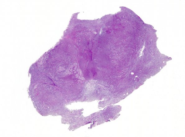 1A1 Medullo (origl tumor, Case 1) H&E WM 2