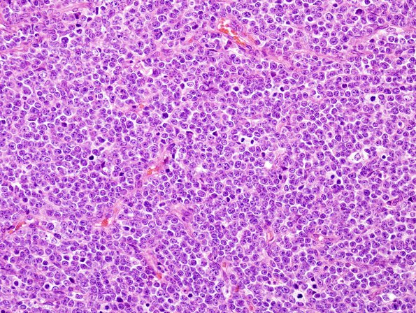 1A2 Medullo (origl tumor, Case 1) H&E 1