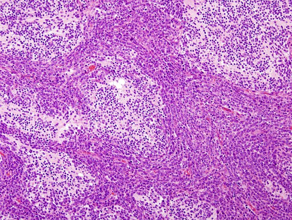 1A4 Medullo (origl tumor, Case 1) H&E 7