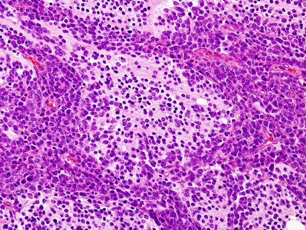 1A5 Medullo (origl tumor, Case 1) H&E 4