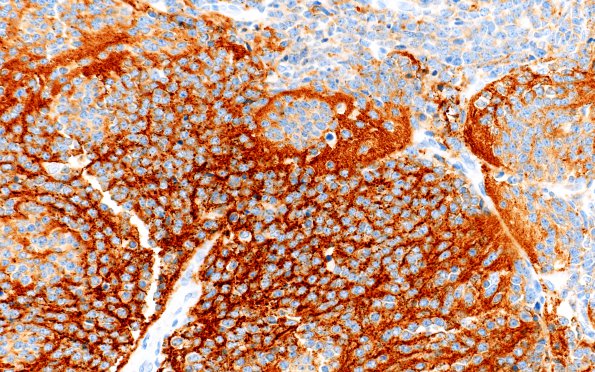 1B3 Medullo c maturation (Case 1) 1 SYN 40X