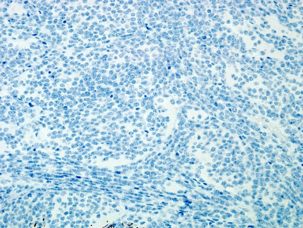 1C2 Medullo (origl tumor, Case 1) GFAP 1