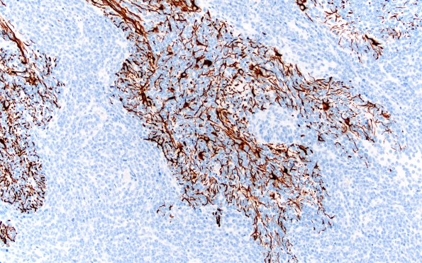 1C3 Medullo c maturation (Case 1) 1 GFAP 20X