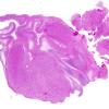 2A1 MB differentiation (Case 1) H&E WM