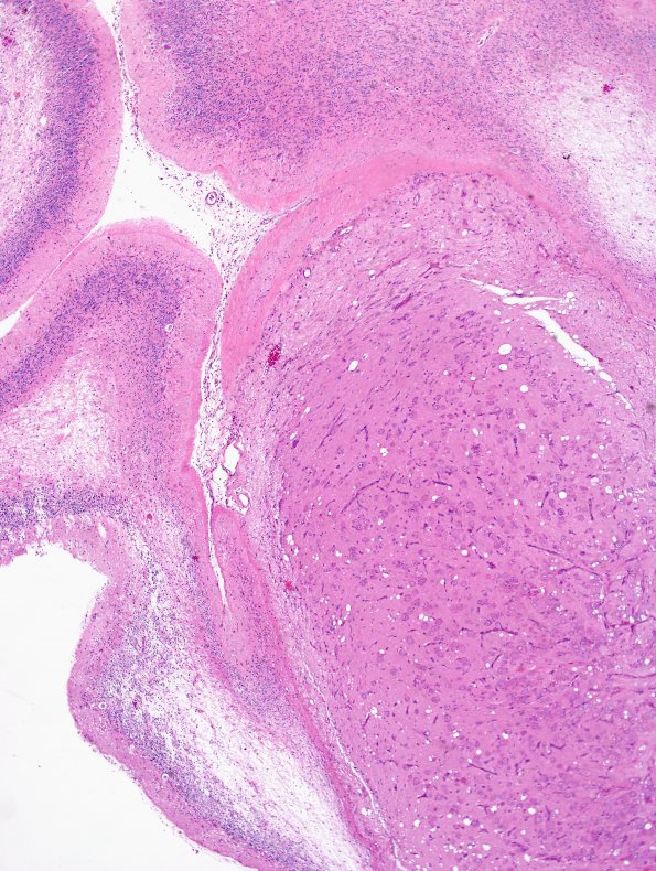 2A3 MB differentiation (Case 1) H&E 9