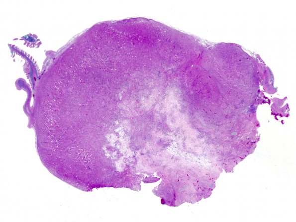 2A4 MB differentiation (Case 1) H&E 2