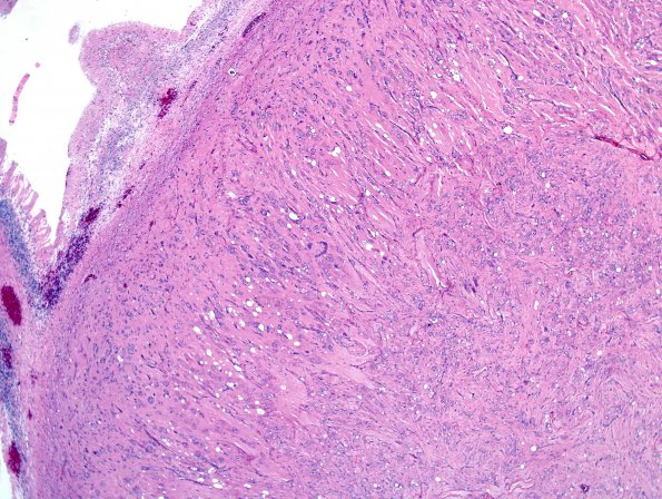 2A5 MB differentiation (Case 1) H&E 8