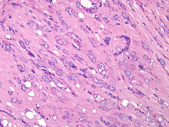 2A6 MB differentiation (Case 1) H&E 5