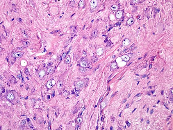 2A7 MB differentiation (Case 1) H&E 2 (2)