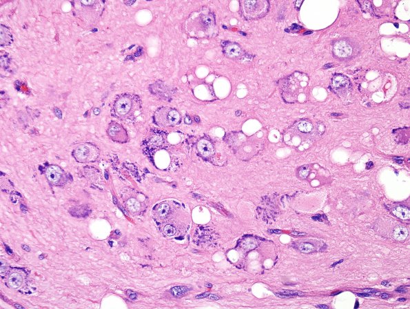 2A8 MB differentiation (Case 1) H&E 4