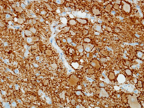 2B4 MB differentiation (Case 1) SYN 4